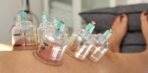 Cupping behandling med vacum cupper